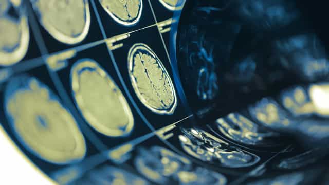 Recuperação de paciente com AVC depende de atendimento rápido – Click Campos